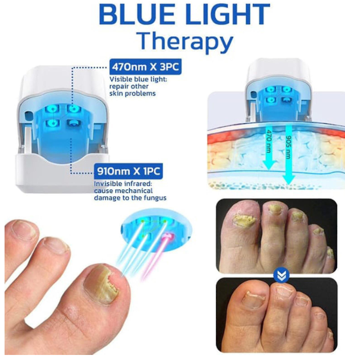 Fungal Nail Treatment (WHITE)